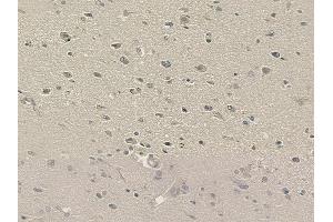 ABIN6264172 and ABIN6273294 at 1/100 staining human glioblastoma by IHC-P. (PHF11 anticorps  (C-Term))