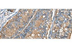 Immunohistochemistry of paraffin-embedded Human gastric cancer tissue using CEACAM8 Polyclonal Antibody at dilution of 1:30(x200) (CEACAM8 anticorps)