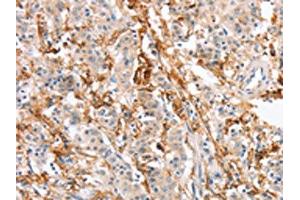 The image on the left is immunohistochemistry of paraffin-embedded Human gastric cancer tissue using ABIN7131059(SIGLEC9 Antibody) at dilution 1/30, on the right is treated with fusion protein. (SIGLEC9 anticorps)