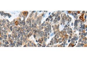 Immunohistochemistry of paraffin-embedded Human thyroid cancer tissue using ATRX Polyclonal Antibody at dilution of 1:50(x200)