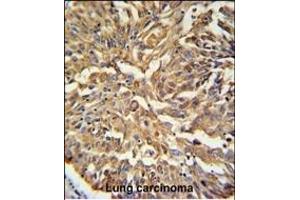 KRT19 Antibody (C-term) (ABIN389327 and ABIN2839443) IHC analysis in formalin fixed and paraffin embedded human Lung carcinoma followed by peroxidase conjugation of the secondary antibody and DAB staining. (Cytokeratin 19 anticorps  (C-Term))