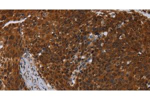Immunohistochemistry of paraffin-embedded Human cervical cancer using MCHR1 Polyclonal Antibody at dilution of 1:30 (MCHR1 anticorps)