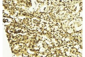 ABIN6267513 at 1/100 staining Human breast cancer tissue by IHC-P. (STAT5 A/B anticorps  (pSer725, pSer730))
