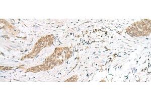 Immunohistochemistry of paraffin-embedded Human esophagus cancer tissue using ENSA Polyclonal Antibody at dilution of 1:40(x200) (Ensa anticorps)