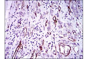 Immunohistochemical analysis of paraffin-embedded liver cancer tissues using GSC mouse mAb with DAB staining.