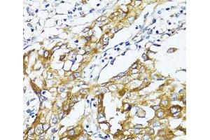 Immunohistochemistry of paraffin-embedded Human liver cancer using GLUT4 Polyclonal Antibody at dilution of 1:100 (40x lens).