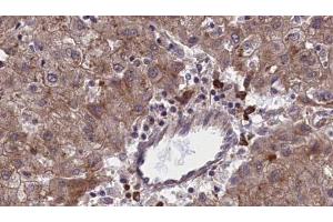 ABIN6273966 at 1/100 staining Human liver cancer tissue by IHC-P.
