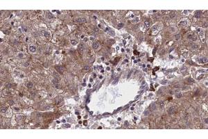 ABIN6273966 at 1/100 staining Human liver cancer tissue by IHC-P. (OR1F1 anticorps  (C-Term))