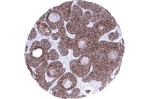 Anal canal Squamous cell carcinoma with strong TRIM29 immunostaining of tumor cells