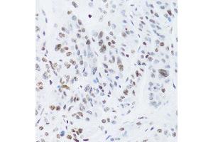 Immunohistochemistry of paraffin-embedded human liver cancer using NFKB2 Antibody.