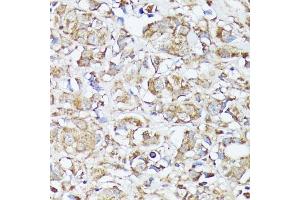 Immunohistochemistry of paraffin-embedded human mammary cancer using MTHFD2 antibody (ABIN6132367, ABIN6144144, ABIN6144145 and ABIN6214625) at dilution of 1:100 (40x lens).