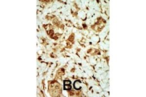 Formalin-fixed and paraffin-embedded human cancer tissue reacted with the primary antibody, which was peroxidase-conjugated to the secondary antibody, followed by DAB staining.