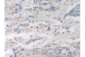 Detection of F8 in Human Breast cancer Tissue using Polyclonal Antibody to Coagulation Factor VIII (F8)