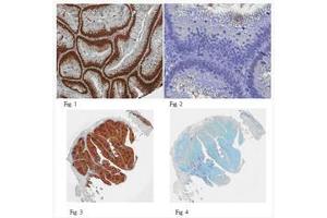 Formalin Fixed Paraffin Embedded (FFPE) human colon adenocarcinoma tissues (Fig. (PCNA anticorps)