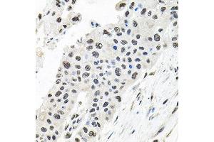 Immunohistochemistry of paraffin-embedded human lung cancer using CDCA8 antibody at dilution of 1:100 (x40 lens). (CDCA8 anticorps)