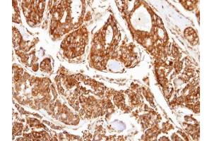 IHC-P Image Immunohistochemical analysis of paraffin-embedded human tyroid cancer, using PPP2R5D, antibody at 1:100 dilution. (PPP2R5D anticorps  (C-Term))