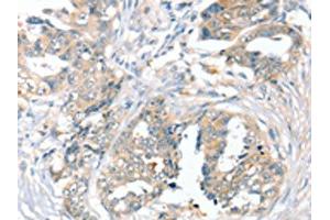 The image on the left is immunohistochemistry of paraffin-embedded Human cervical cancer tissue using ABIN7192539(SLC9A9 Antibody) at dilution 1/45, on the right is treated with synthetic peptide. (SLC9A9 anticorps)