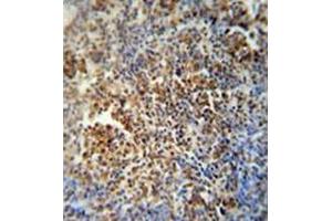 Immunohistochemistry analysis in formalin fixed and paraffin embedded human lung carcinoma reacted with MAF1 Antibody (Center) followed which was peroxidase conjugated to the secondary antibody and followed by DAB staining.