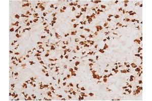 ABIN6267604 at 1/200 staining Human lung cancer tissue sections by IHC-P.