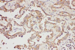 Anti-Galectin 3 Picoband antibody,  IHC(P): Human Lung Cancer Tissue (Galectin 3 anticorps  (AA 139-250))
