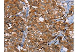 The image on the left is immunohistochemistry of paraffin-embedded Human breast cancer tissue using ABIN7191755(P2RY1 Antibody) at dilution 1/40, on the right is treated with synthetic peptide. (P2RY1 anticorps)