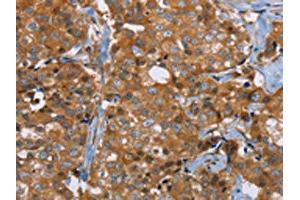 The image on the left is immunohistochemistry of paraffin-embedded Human breast cancer tissue using ABIN7191755(P2RY1 Antibody) at dilution 1/40, on the right is treated with synthetic peptide. (P2RY1 anticorps)