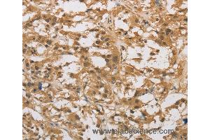 Immunohistochemistry of Human thyroid cancer using DAB2 Polyclonal Antibody at dilution of 1:30 (DAB2 anticorps)