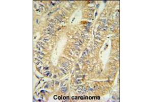 HPGD Antibody IHC analysis in formalin fixed and paraffin embedded human colon carcinoma followed by peroxidase conjugation of the secondary antibody and DAB staining.