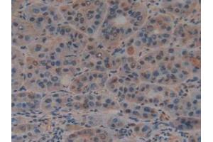IHC-P analysis of Human Liver Cancer Tissue, with DAB staining. (PTF1A anticorps  (AA 177-328))