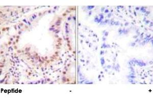 Immunohistochemical analysis of paraffin-embedded human lung carcinoma tissue using ETS1 polyclonal antibody . (ETS1 anticorps)