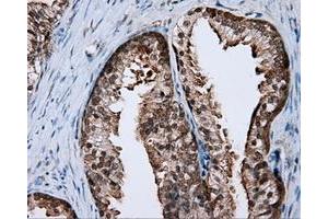 Immunohistochemical staining of paraffin-embedded Carcinoma of liver tissue using anti-RALBP1 mouse monoclonal antibody. (RALBP1 anticorps)
