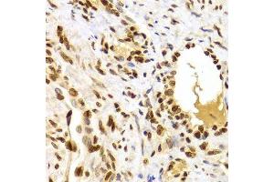 Immunohistochemistry of paraffin-embedded human adenomyosis using HMGB1 Antibody. (HMGB1 anticorps  (AA 100-200))