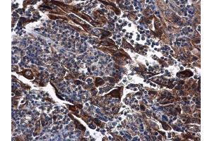 IHC-P Image DNase I antibody [N1C3] detects DNase I protein at cytoplasm in human endometrial carcinoma by immunohistochemical analysis.