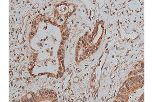 ABIN6268858 at 1/50 staining human colon cancer tissue sections by IHC-P. (MCL-1 anticorps  (Internal Region))