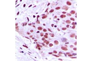 Immunohistochemical analysis of MCM2 staining in human breast cancer formalin fixed paraffin embedded tissue section. (MCM2 anticorps  (N-Term))