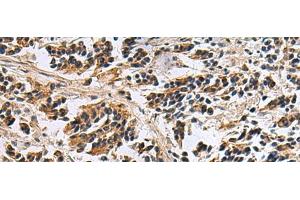 Immunohistochemistry of paraffin-embedded Human breast cancer tissue using DIAPH2 Polyclonal Antibody at dilution of 1:55(x200) (DIAPH2 anticorps)