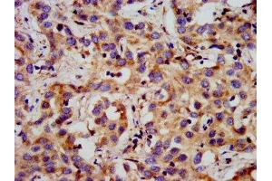 IHC image of ABIN7153315 diluted at 1:300 and staining in paraffin-embedded human liver cancer performed on a Leica BondTM system. (G Protein-Coupled Receptor 1 anticorps  (AA 308-355))