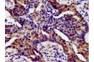 IHC image of ABIN7155739 diluted at 1:500 and staining in paraffin-embedded human lung cancer performed on a Leica BondTM system. (HOXB4 anticorps  (AA 88-166))
