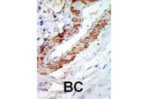 Formalin-fixed and paraffin-embedded human cancer tissue reacted with the primary antibody, which was peroxidase-conjugated to the secondary antibody, followed by DAB staining. (MAP3K8 anticorps  (C-Term))