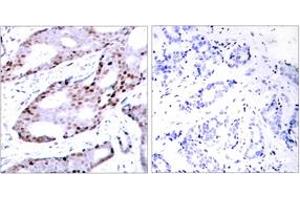 Immunohistochemistry analysis of paraffin-embedded human breast carcinoma tissue, using c-Jun (Ab-73) Antibody. (C-JUN anticorps  (AA 40-89))