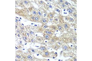 Immunohistochemistry of paraffin-embedded human liver injury using QARS antibody. (QARS anticorps)
