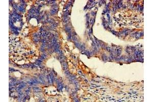 Immunohistochemistry of paraffin-embedded human colon cancer using ABIN7158800 at dilution of 1:100 (SCARB2 anticorps  (AA 47-128))