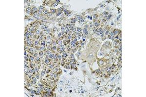 Immunohistochemistry of paraffin-embedded human lung cancer using VEPH1 antibody. (VEPH1 anticorps  (AA 448-547))