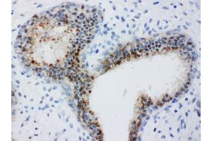 Anti-Bub3 antibody, IHC(P) IHC(P): Human Mammary Cancer Tissue