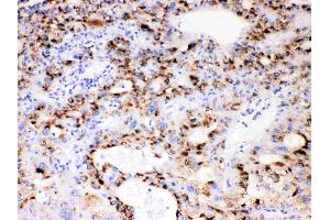 CYP3A4 was detected in paraffin-embedded sections of human liver cancer tissues using rabbit anti- CYP3A4 Antigen Affinity purified polyclonal antibody (Catalog # ) at 1 µg/mL. (CYP3A4 anticorps  (Middle Region))