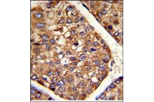 AP17615PU-N P4HB antibody staining of Formalin-Fixed and paraffin-Embedded Human hepatocarcinoma using peroxidase-conjugated to the secondary antibody, followed by DAB staining. (P4HB anticorps  (C-Term))