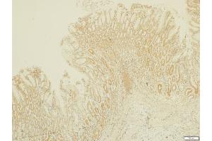 IHC-P Image MMP17 antibody [N2C2], Internal detects MMP17 protein at cytosol on human gastria carcinoma by immunohistochemical analysis. (MMP17 anticorps)