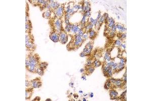 Immunohistochemistry of paraffin-embedded human liver cancer using GLUD2 antibody. (GLUD2 anticorps  (AA 319-558))
