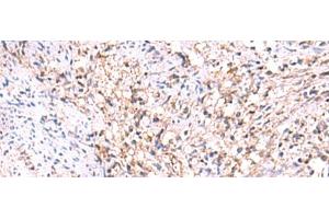 Immunohistochemistry of paraffin-embedded Human cervical cancer tissue using MANSC1 Polyclonal Antibody at dilution of 1:105(x200) (MANSC1 anticorps)
