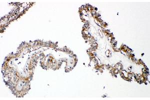 Anti-Parathyroid Hormone Receptor 1 antibody, IHC(P) IHC(P): Human Thyroid Cancer Tissue (PTH1R anticorps  (C-Term))